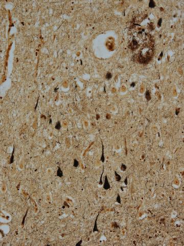 Brain tangles